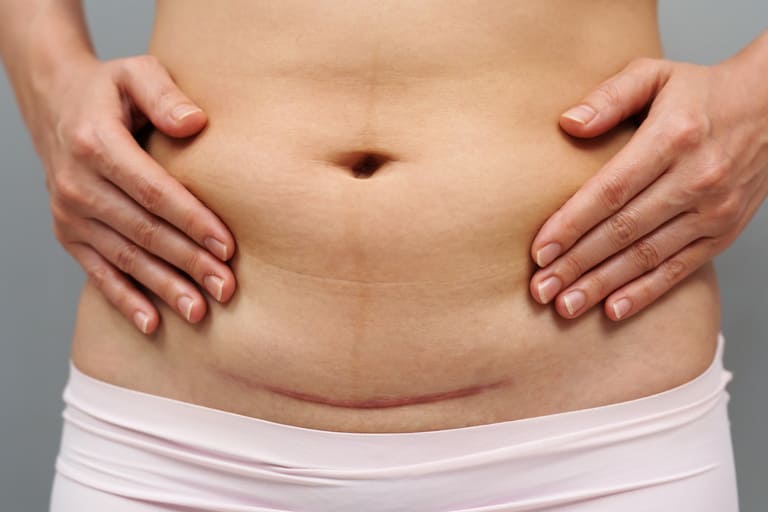 Narbenfaszien & Verklebungen lösen